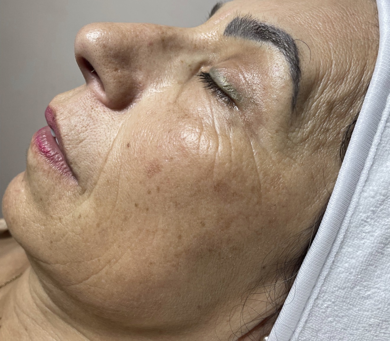 Antes de tratamiento facial en Estética SanVi, San Vicente de Tagua Tagua