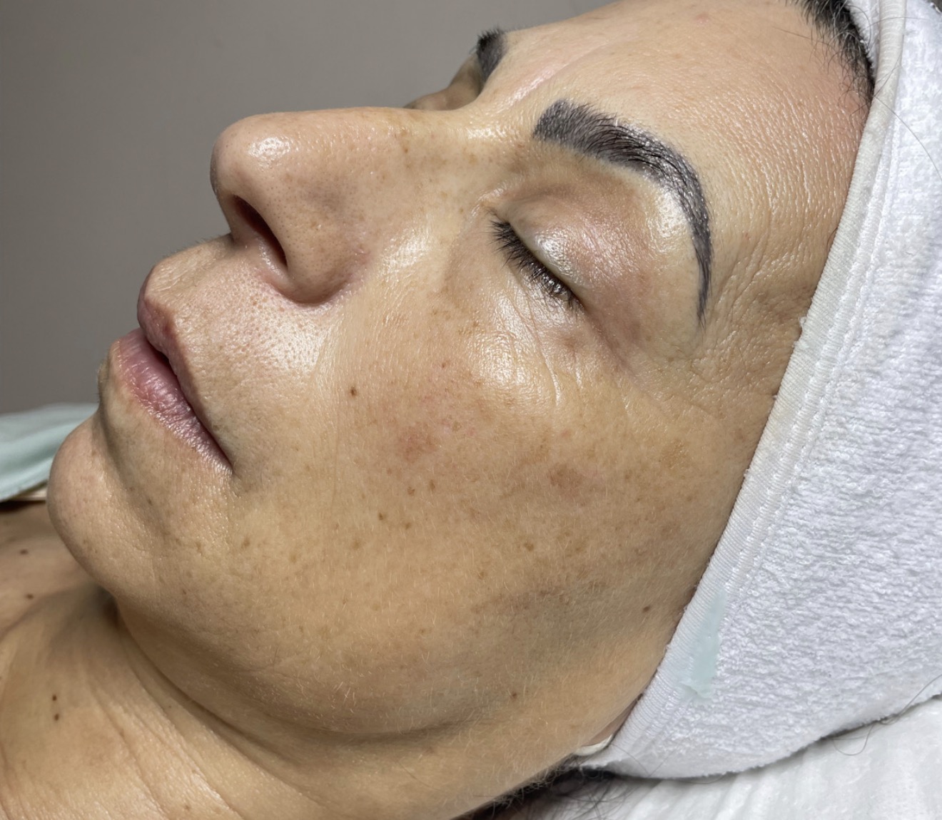 Después de tratamiento facial en Estética SanVi, San Vicente de Tagua Tagua