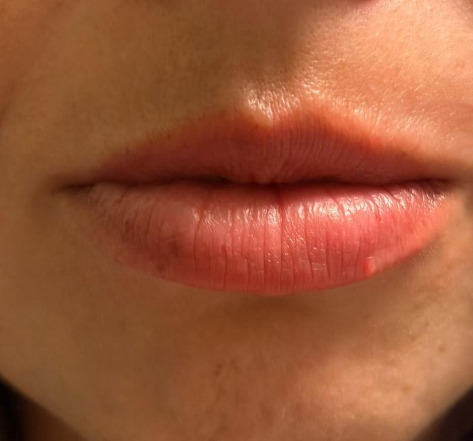 Antes de micropigmentación de labios – Estética SanVi San Vicente de Tagua Tagua