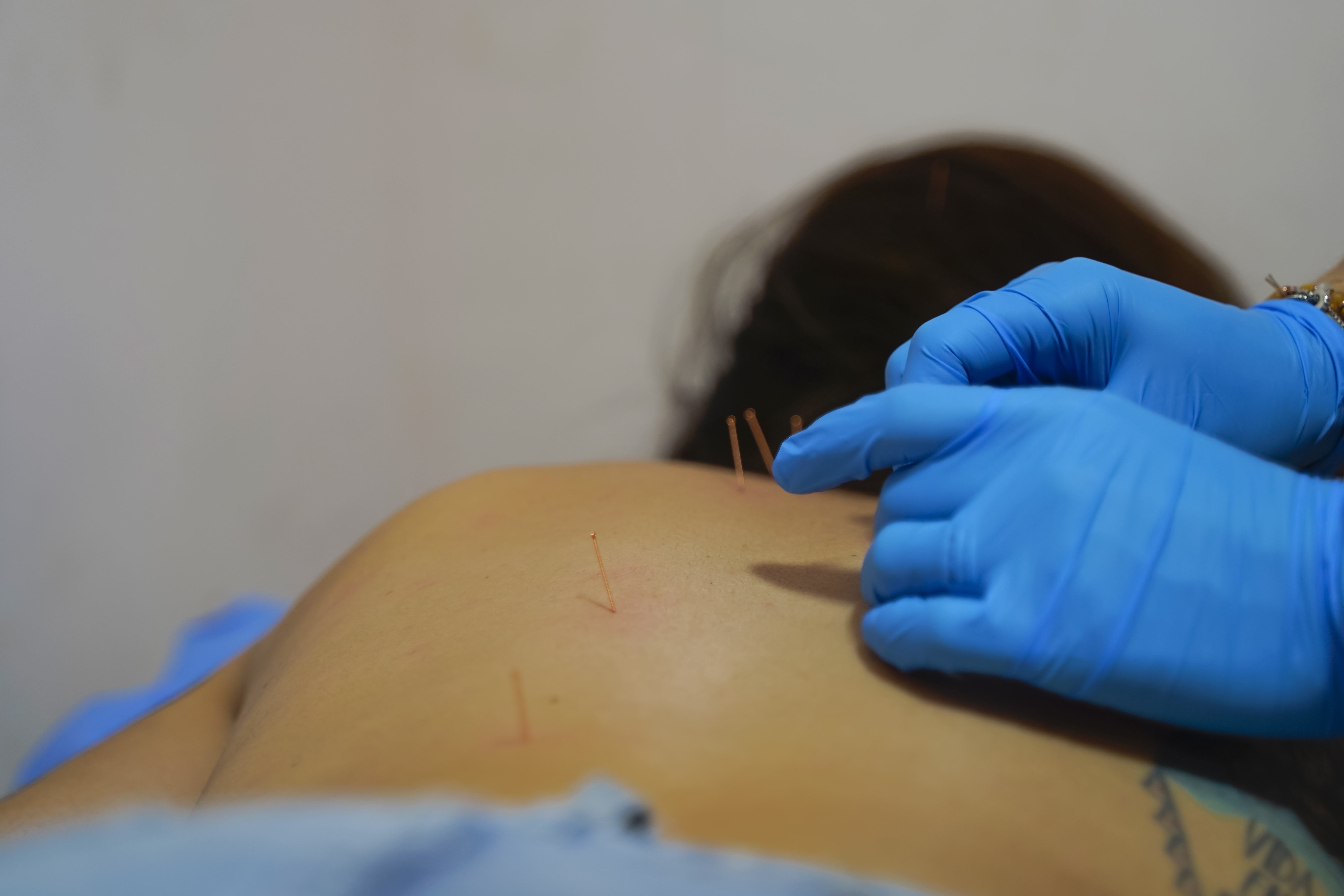 Acupuntura terapéutica en Estética SanVi, San Vicente de Tagua Tagua